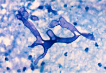 ঢাকায় একজনের মৃত্যু, ব্ল্যাক ফাঙ্গাস বলে সন্দেহ